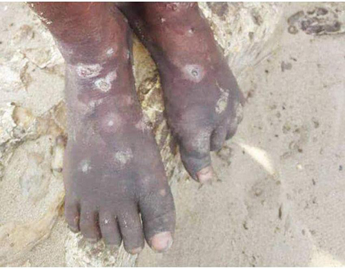 Scabies patients resort to traditional remedies