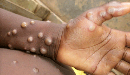 Monkeypox declared global health emergency