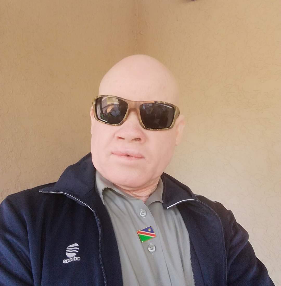 People with albinism gripped by fear