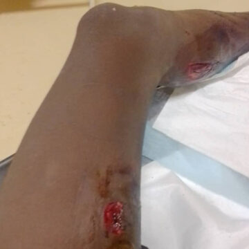 Teen attacked by hippo in Kavango River