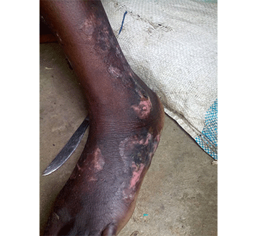 Ash burn victim wants compensation 