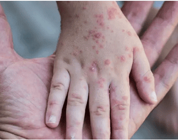 Monkeypox: Namibians urged to remain calm