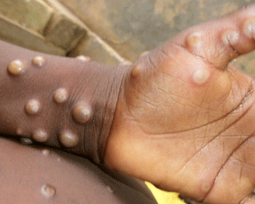 Monkeypox declared global health emergency