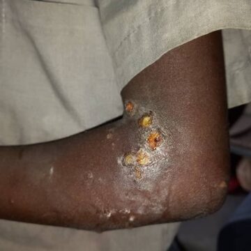 Scabies outbreak disrupts schools