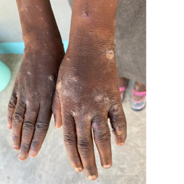 Oshikoto learners battle scabies