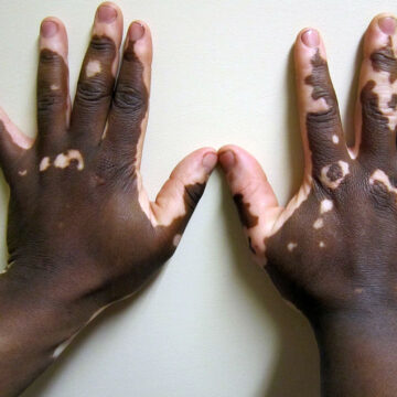 Sunday is World Vitiligo Day