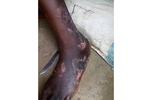 Ash burn victim wants compensation 