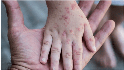 Monkeypox: Namibians urged to remain calm