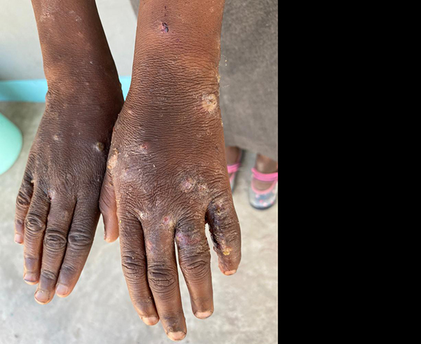 Ovanafikola 213 va kwatwa konghana mOshikoto