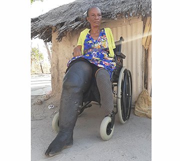 snake bite ‘Onduda oyo nda tungilwa nghi wete handi i nangala’…Omukainhu a lemanekwa komayoka a kanifa omukumo weveluko