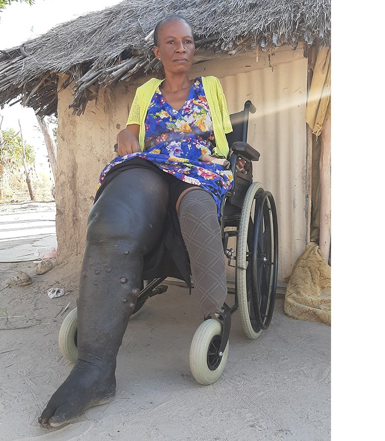 Snakebite torments woman