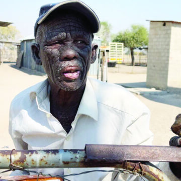 ‘I am just waiting to die’ – Nuxab… A villager’s battle with psoriasis