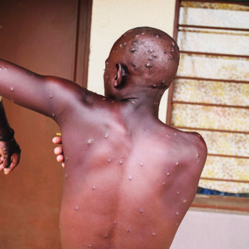 Mpox outbreak can be stopped – WHO