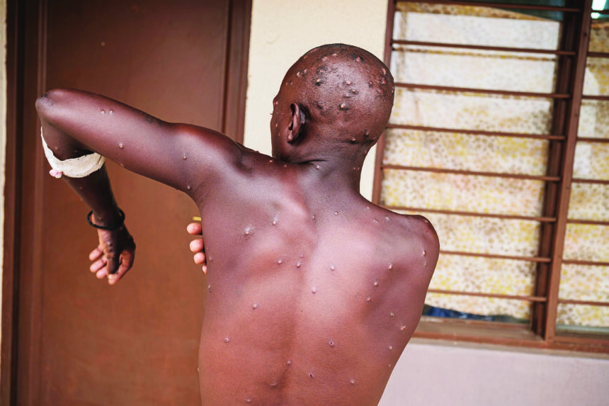 Mpox outbreak can be stopped – WHO