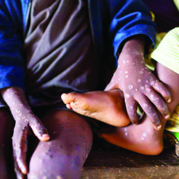 Mpox declared public health emergency