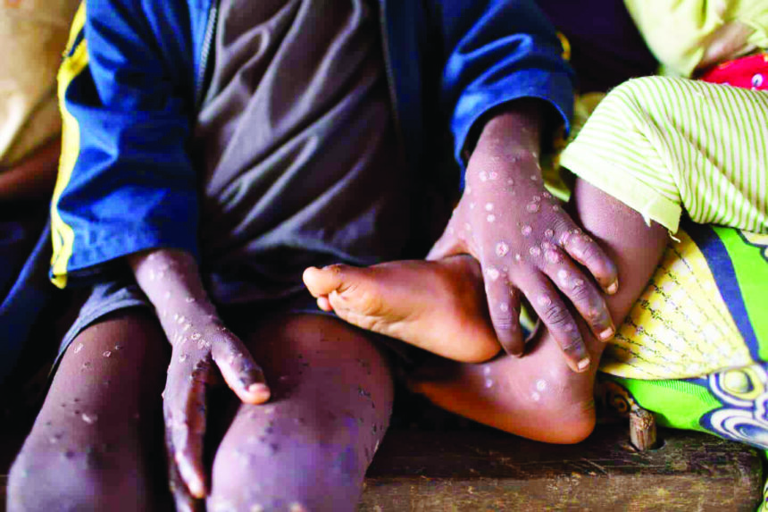 Mpox declared public health emergency