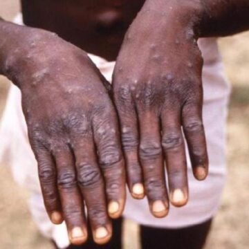 Mpox Sierra Leone reports first case of Mpox