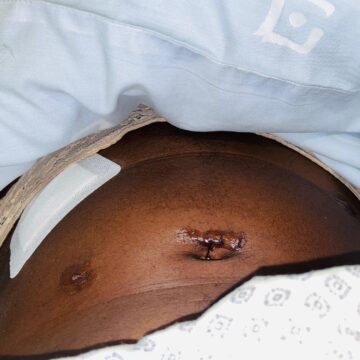 Endo 2 Endometriosis, a woman’s indescribable inner pain