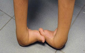 Club foot clinic restores dignity for children 
