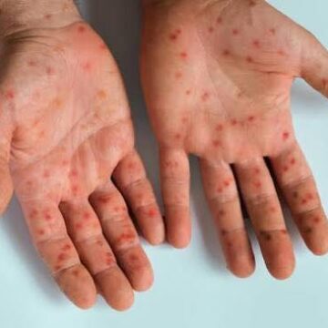 measles Outbreak Measles outbreak in Kunene …at least 10 confirmed cases