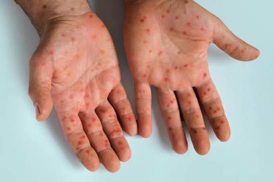 measles Outbreak Measles outbreak in Kunene …at least 10 confirmed cases