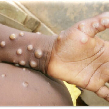Namibia records second Mpox case
